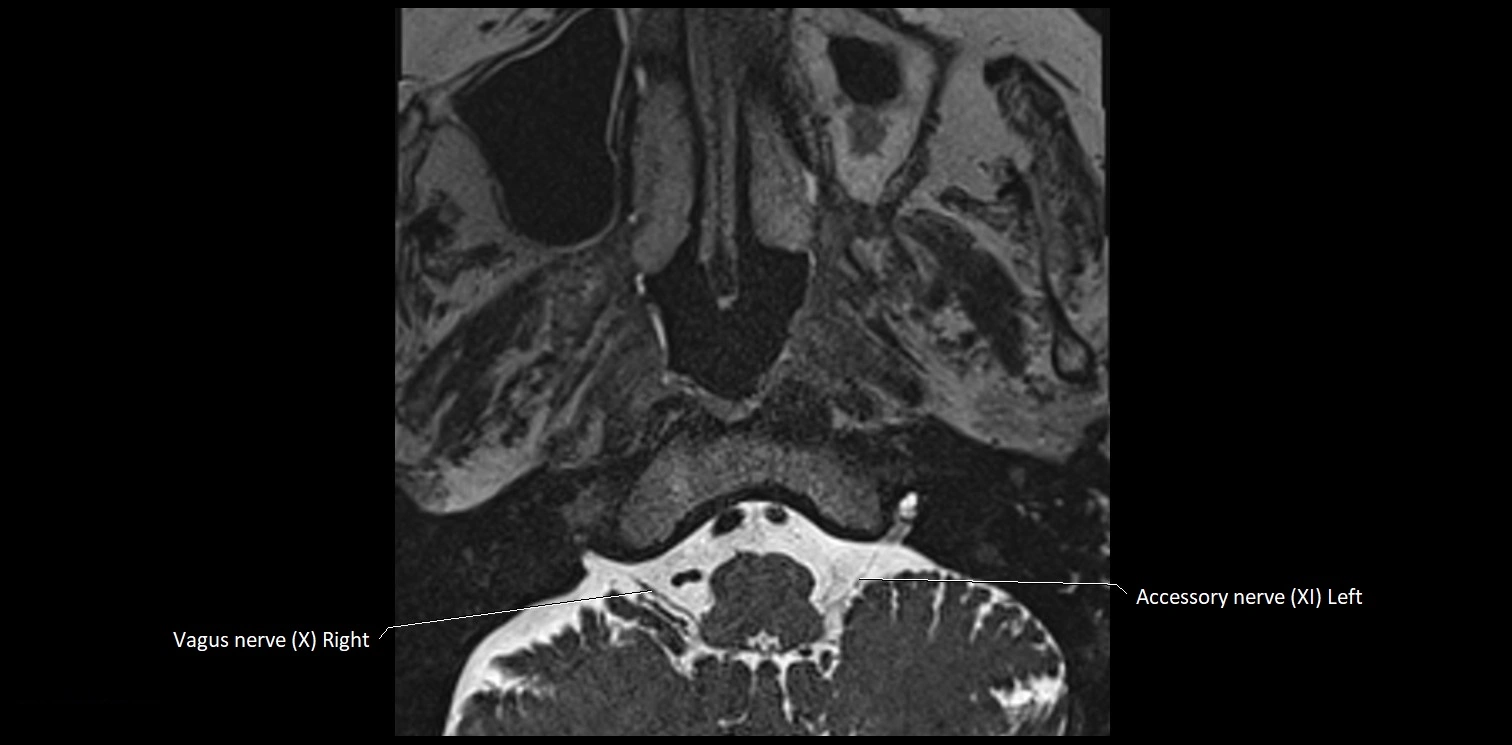 Cranial nerve anatomy axial MRI 3T image 72.webp